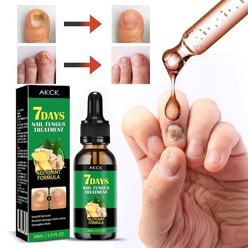 🦶✨ Recupera tus uñas en 7 días y deja de esconder tus pies para siempre.  🌿 Actúa desde la primera aplicación eliminando hongos visibles y ocultos, ayudándote a lograr uñas limpias en solo 7 días y la seguridad de volver a mostrarlas sin vergüenza